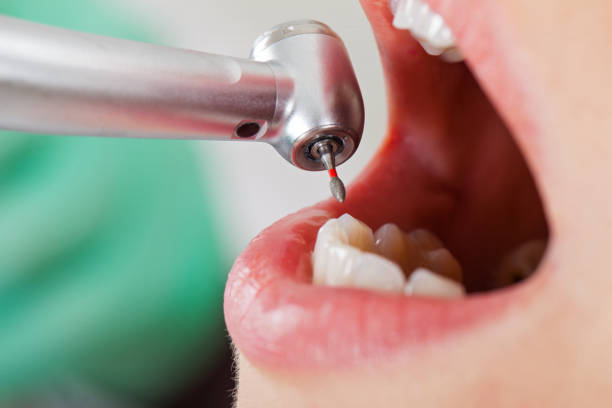 Best Emergency Wisdom Tooth Extraction in Decatur, MI